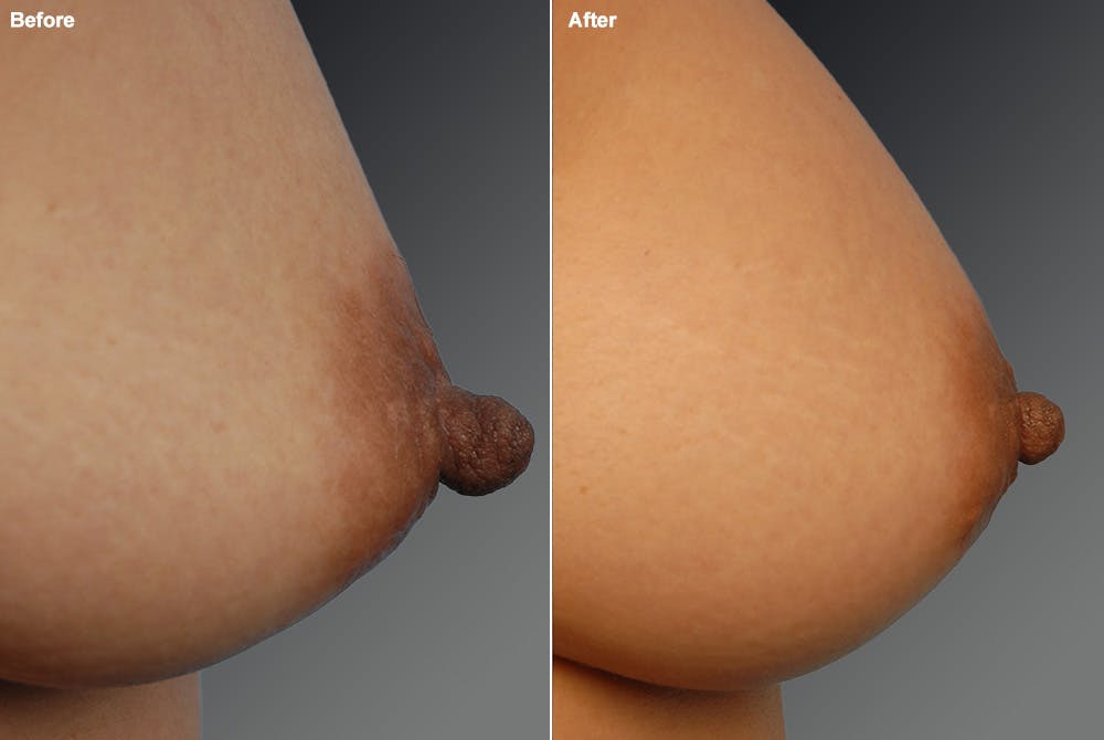 Nipple Reduction Before & After Gallery - Patient 105667065 - Image 1