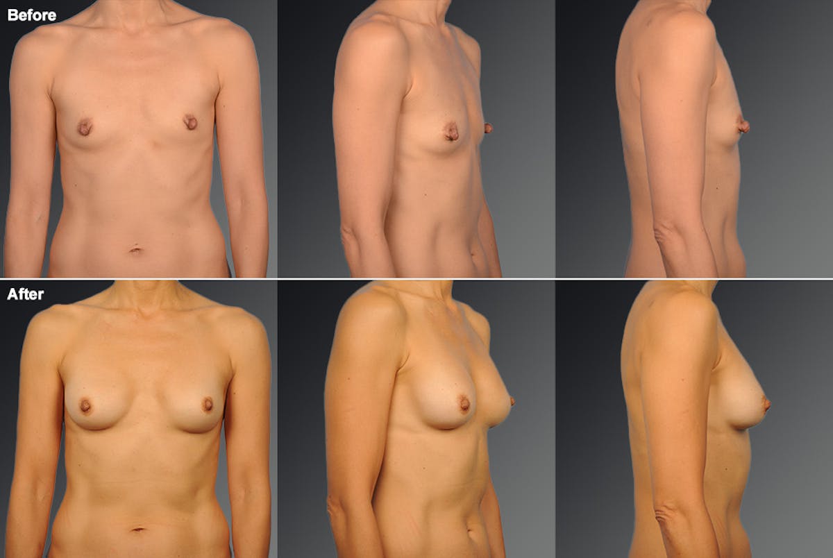 Nipple Reduction Before & After Gallery - Patient 105667067 - Image 1