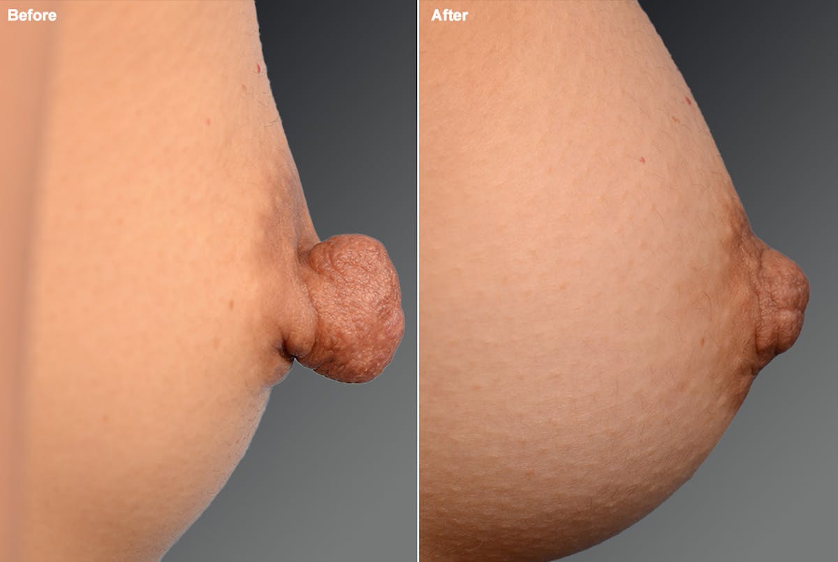 Nipple Reduction Before & After Gallery - Patient 105667078 - Image 1
