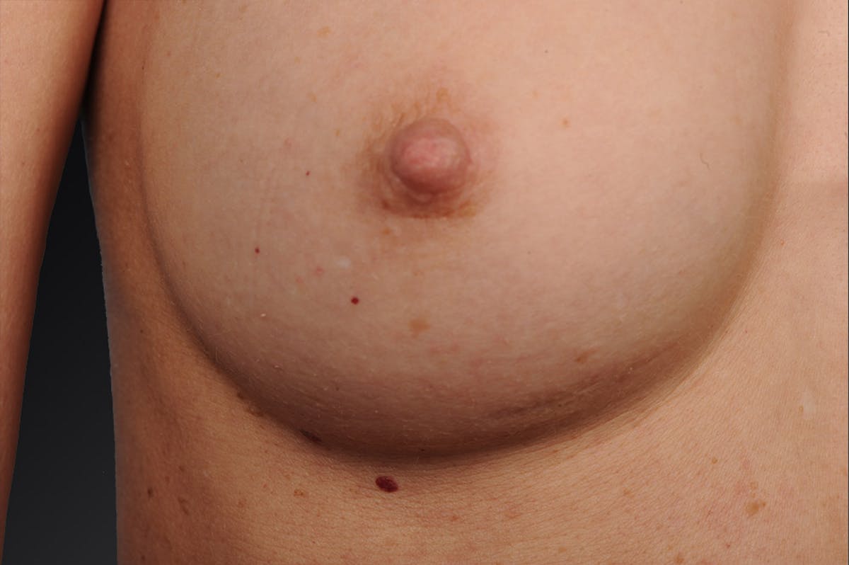 Breast Scar Closeups Before & After Gallery - Patient 105694321 - Image 1