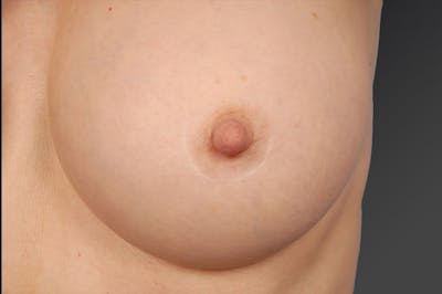 Breast Scar Closeups Before & After Gallery - Patient 105694322 - Image 1