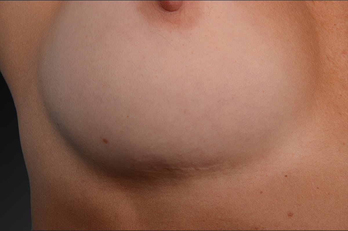 Breast Scar Closeups Before & After Gallery - Patient 105694325 - Image 1