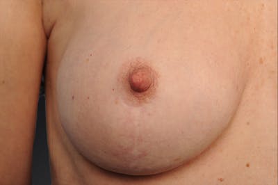 Breast Scar Closeups Before & After Gallery - Patient 105694343 - Image 1