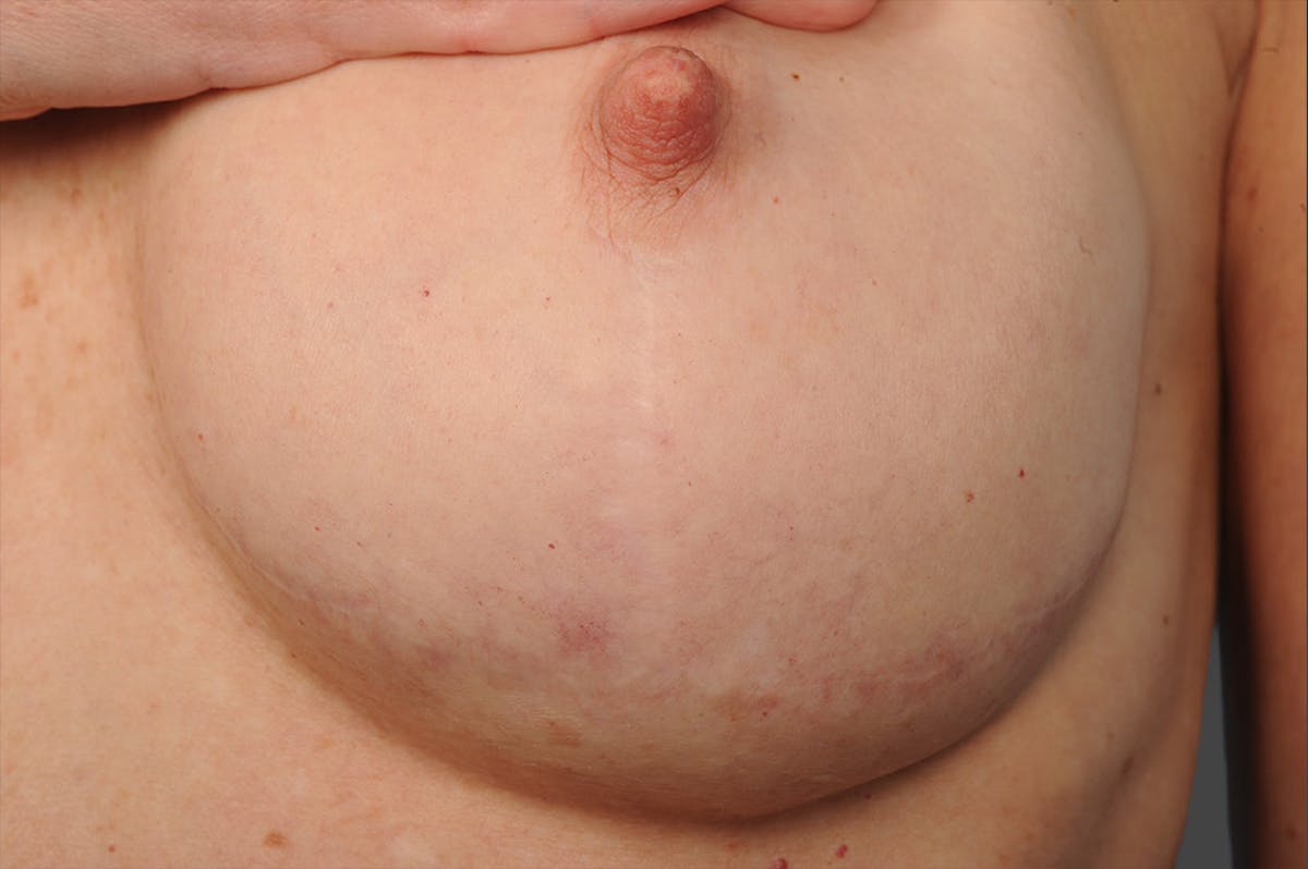 Breast Scar Closeups Before & After Gallery - Patient 105694352 - Image 1