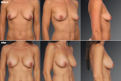 Breast Scar Closeups Before & After Gallery - Patient 105696589 - Image 1