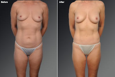 Mommy Makeover Before & After Gallery - Patient 105714132 - Image 1