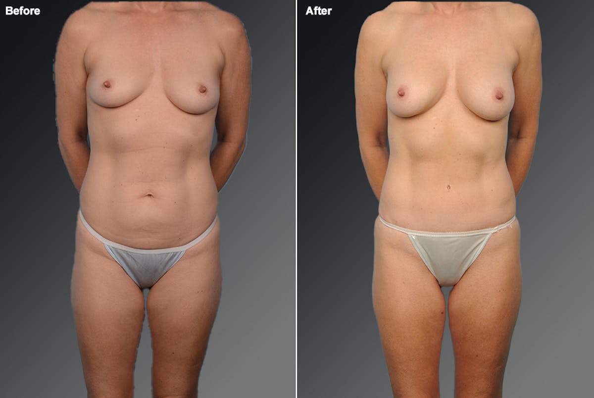Mommy Makeover Before & After Gallery - Patient 105714132 - Image 1
