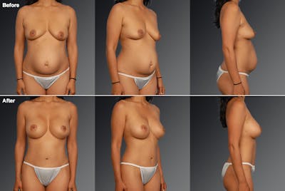Mommy Makeover Before & After Gallery - Patient 105714133 - Image 1