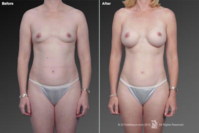 Mommy Makeover Before & After Gallery - Patient 105714136 - Image 1
