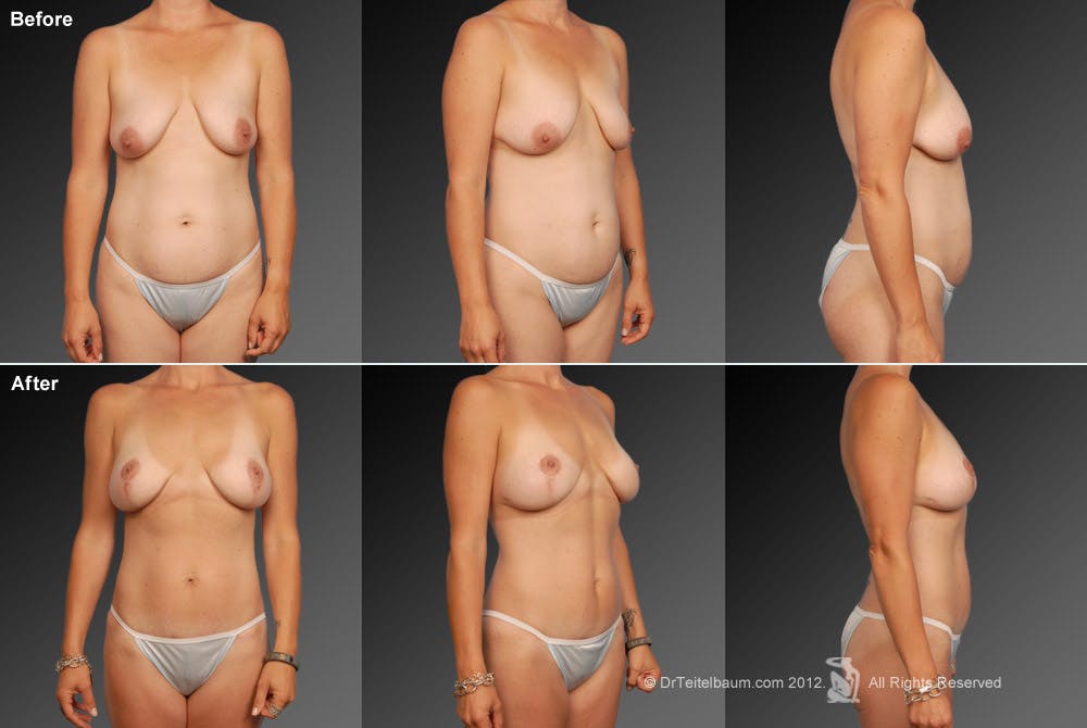 Mommy Makeover Before & After Gallery - Patient 105714141 - Image 1