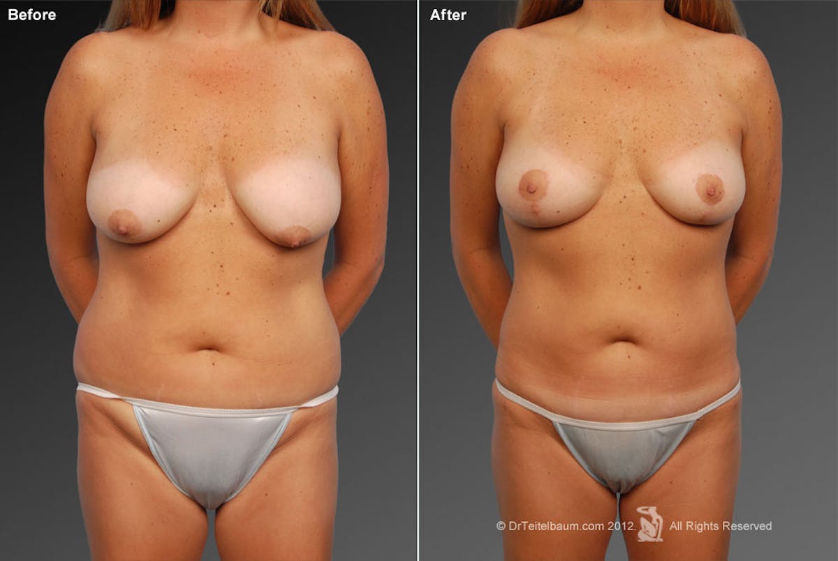 Mommy Makeover Before & After Gallery - Patient 105714145 - Image 1