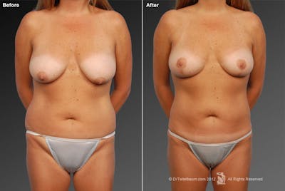 Mommy Makeover Before & After Gallery - Patient 105714145 - Image 1