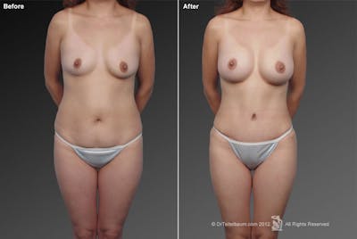 Mommy Makeover Before & After Gallery - Patient 105714150 - Image 1