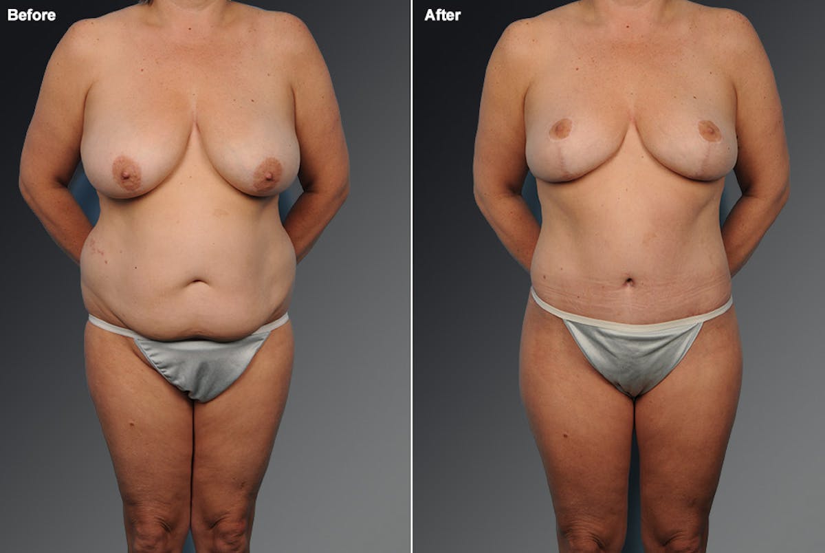 Mommy Makeover Before & After Gallery - Patient 105741253 - Image 1