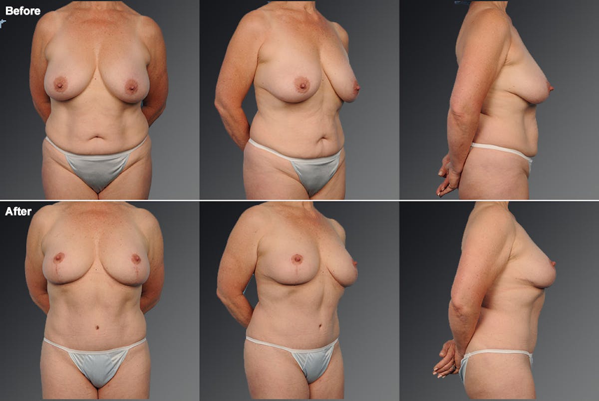 Mommy Makeover Before & After Gallery - Patient 105741254 - Image 1