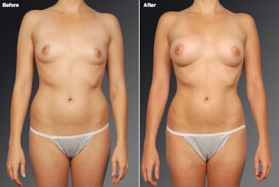 Mommy Makeover Before & After Gallery - Patient 105741255 - Image 1