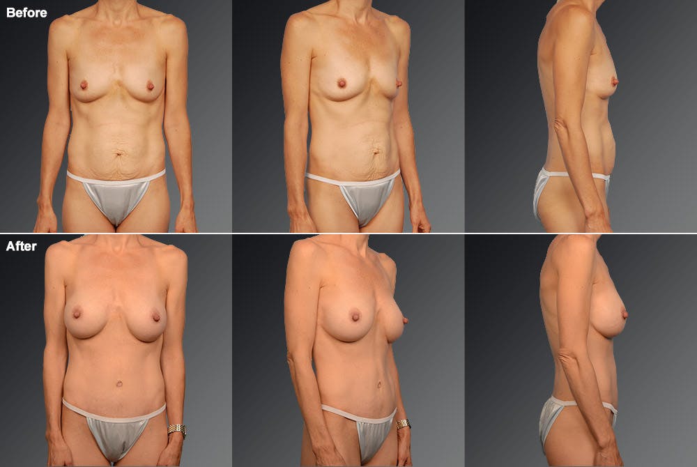 Mommy Makeover Before & After Gallery - Patient 105741257 - Image 1