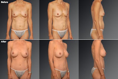 Mommy Makeover Before & After Gallery - Patient 105741257 - Image 1