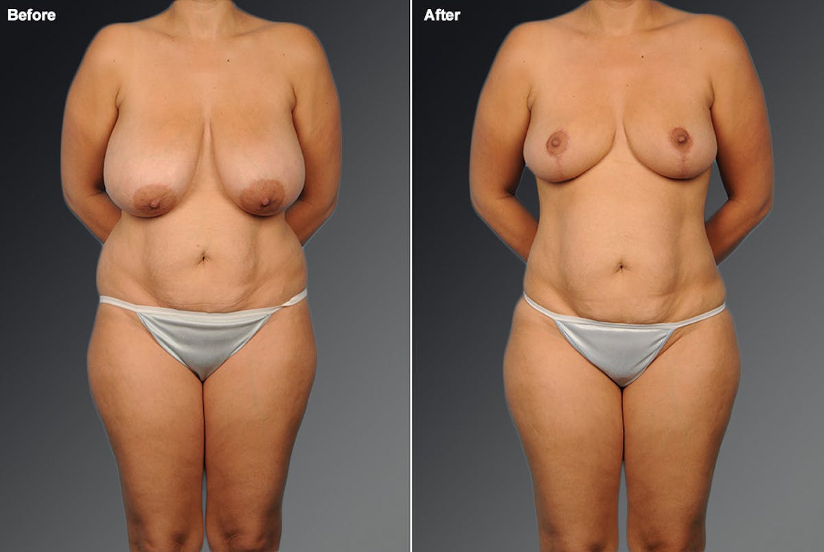Mommy Makeover Before & After Gallery - Patient 105742259 - Image 1