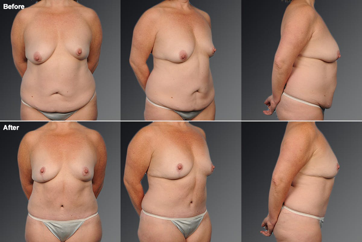 Mommy Makeover Before & After Gallery - Patient 105747728 - Image 1