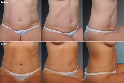 Mommy Makeover Before & After Gallery - Patient 105747734 - Image 1
