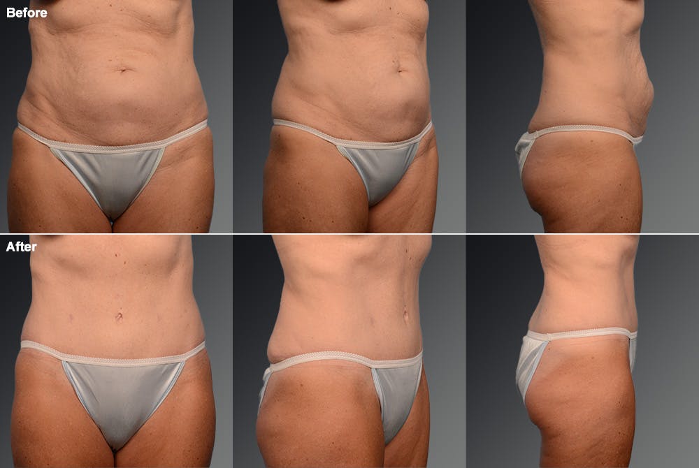 Tummy Tuck Before & After Gallery - Patient 105747878 - Image 1