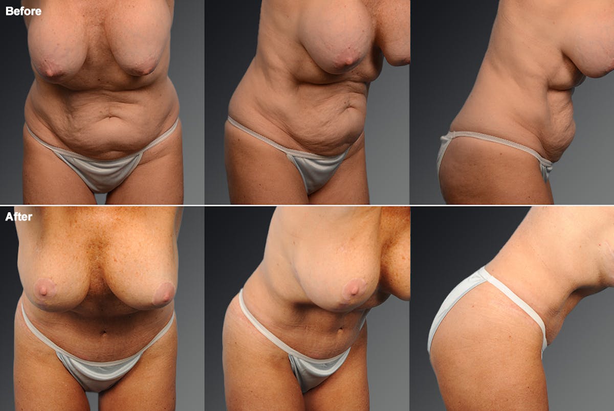 Tummy Tuck Before & After Gallery - Patient 105747879 - Image 1