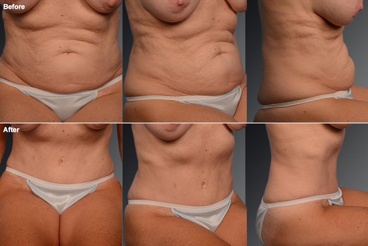 Tummy Tuck Before & After Gallery - Patient 105747883 - Image 1