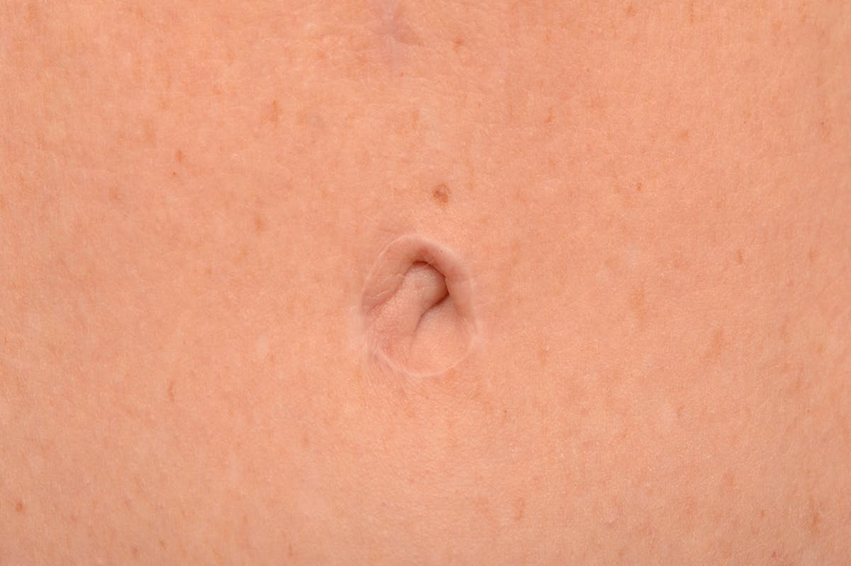 Tummy Tuck Before & After Gallery - Patient 105747884 - Image 1