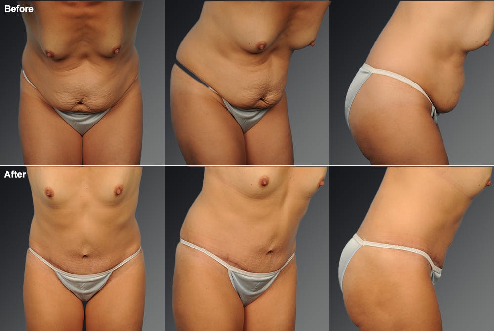 Tummy Tuck Before & After Gallery - Patient 105747885 - Image 1