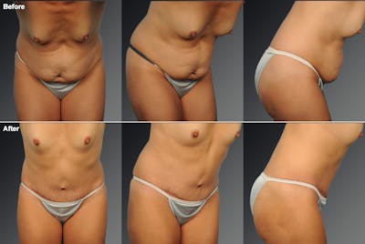 Tummy Tuck Before & After Gallery - Patient 105747885 - Image 1