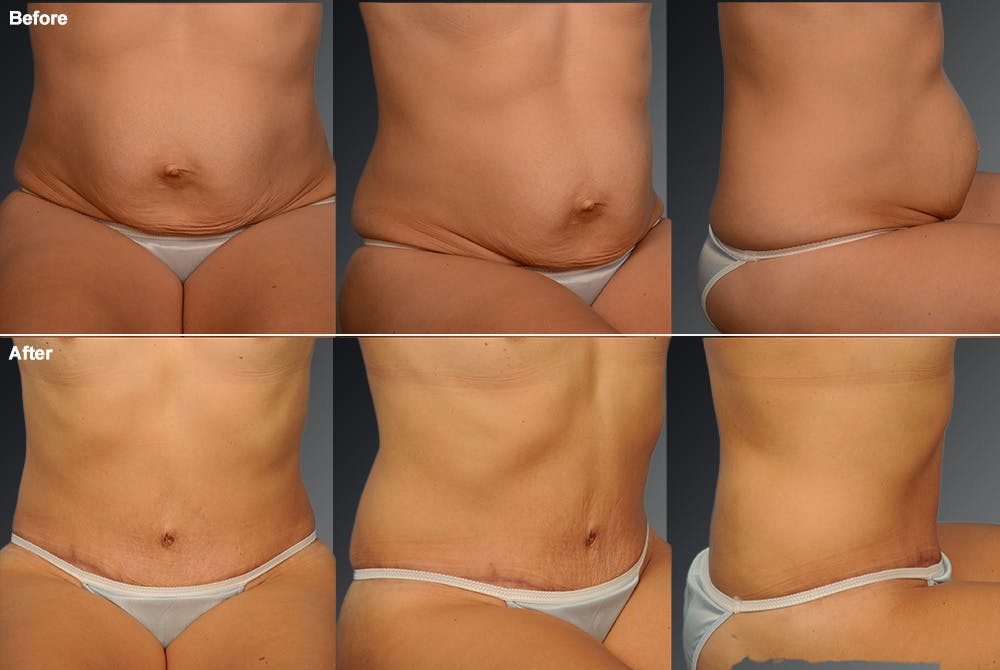 Tummy Tuck Before & After Gallery - Patient 105747887 - Image 1