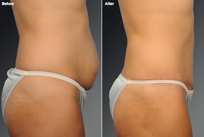 Tummy Tuck Before & After Gallery - Patient 105747888 - Image 1