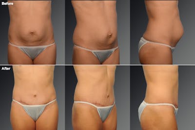 Tummy Tuck Before & After Gallery - Patient 105747891 - Image 1
