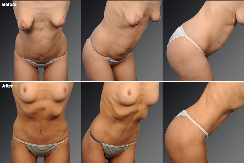 Tummy Tuck Before & After Gallery - Patient 105747893 - Image 1