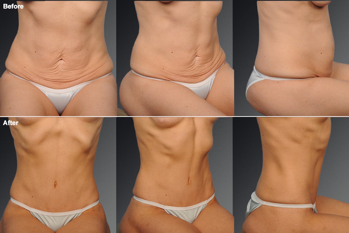 Tummy Tuck Before & After Gallery - Patient 105747894 - Image 1