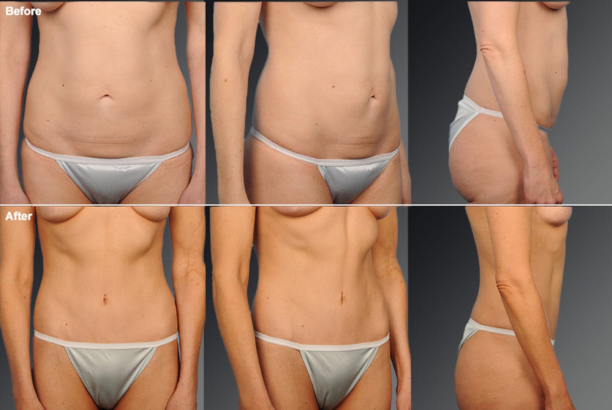 Tummy Tuck Before & After Gallery - Patient 105747895 - Image 1