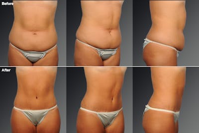 Tummy Tuck Before & After Gallery - Patient 105747896 - Image 1