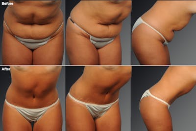 Tummy Tuck Before & After Gallery - Patient 105747898 - Image 1