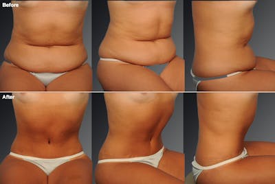 Tummy Tuck Before & After Gallery - Patient 105747899 - Image 1
