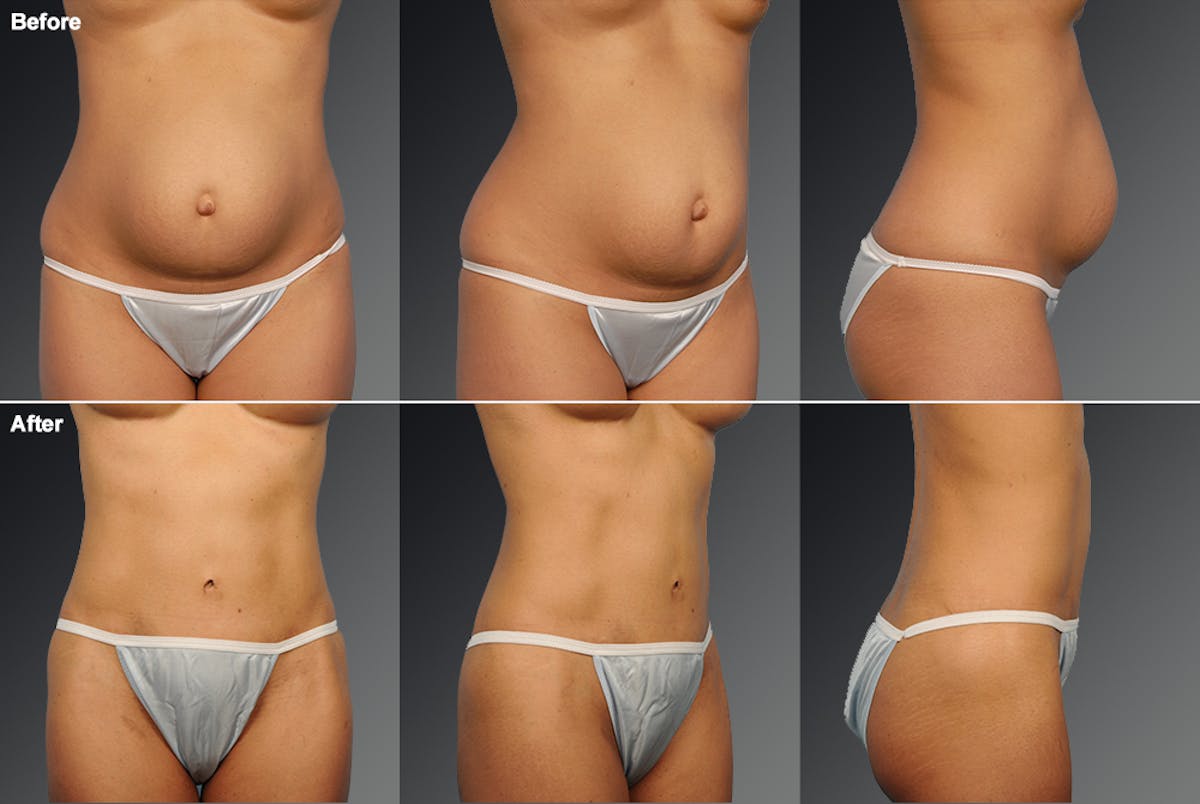 Tummy Tuck Before & After Gallery - Patient 105747902 - Image 1