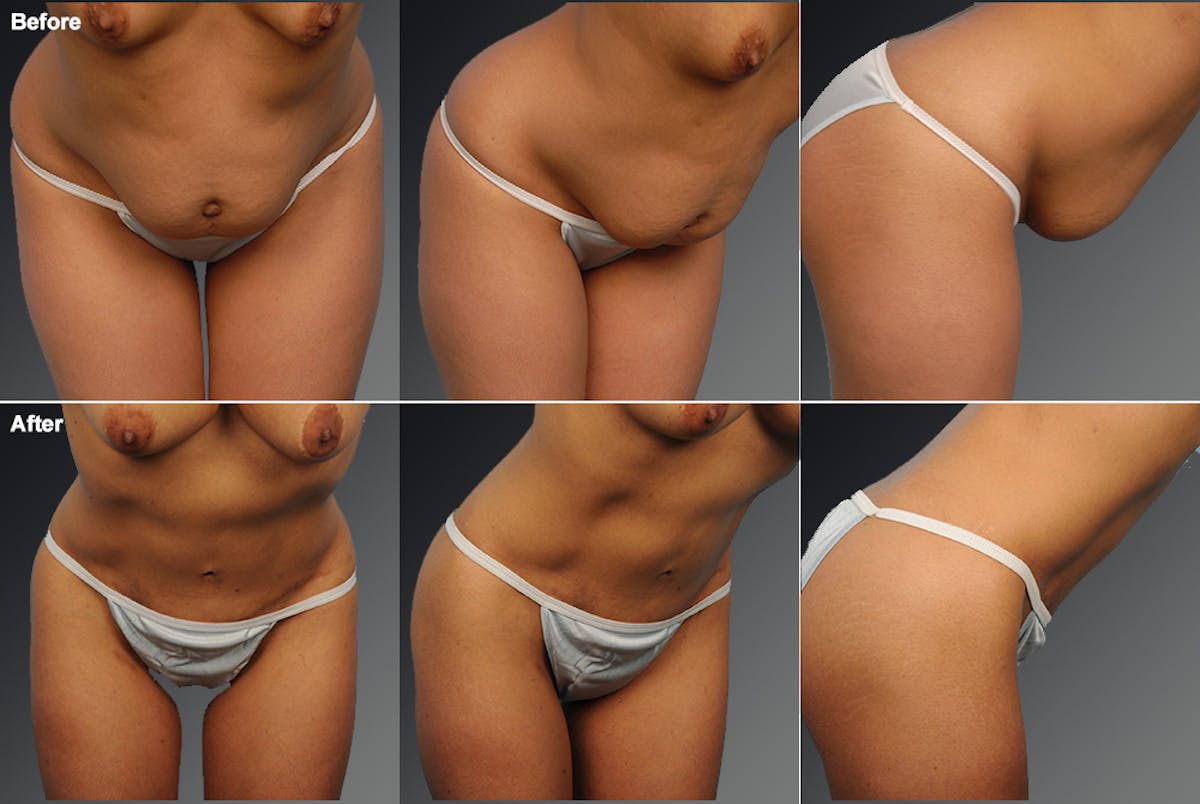 Tummy Tuck Before & After Gallery - Patient 105747904 - Image 1