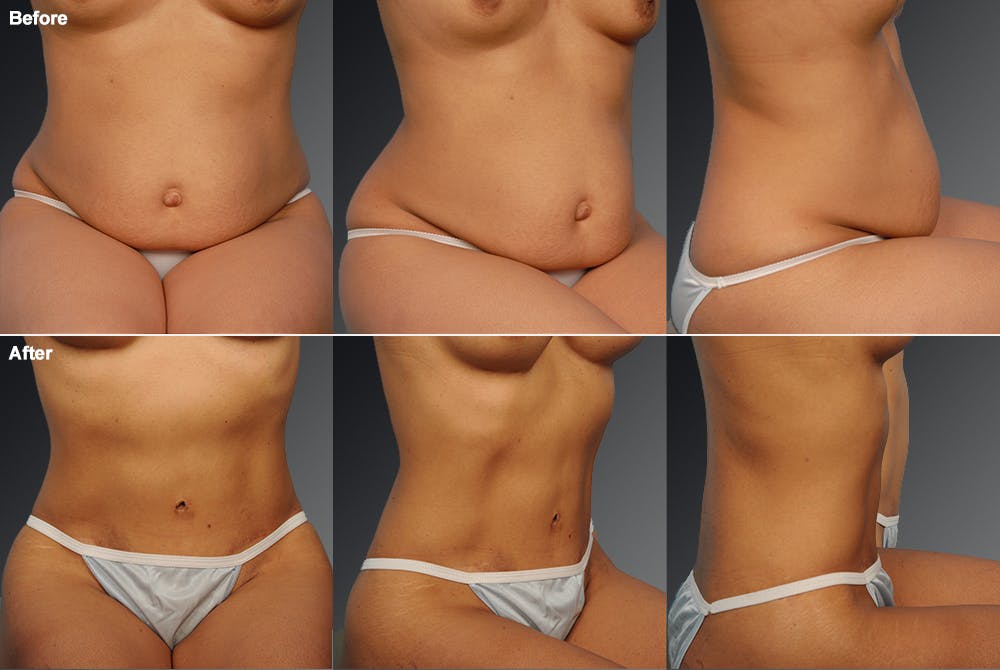 Tummy Tuck Before & After Gallery - Patient 105747911 - Image 1