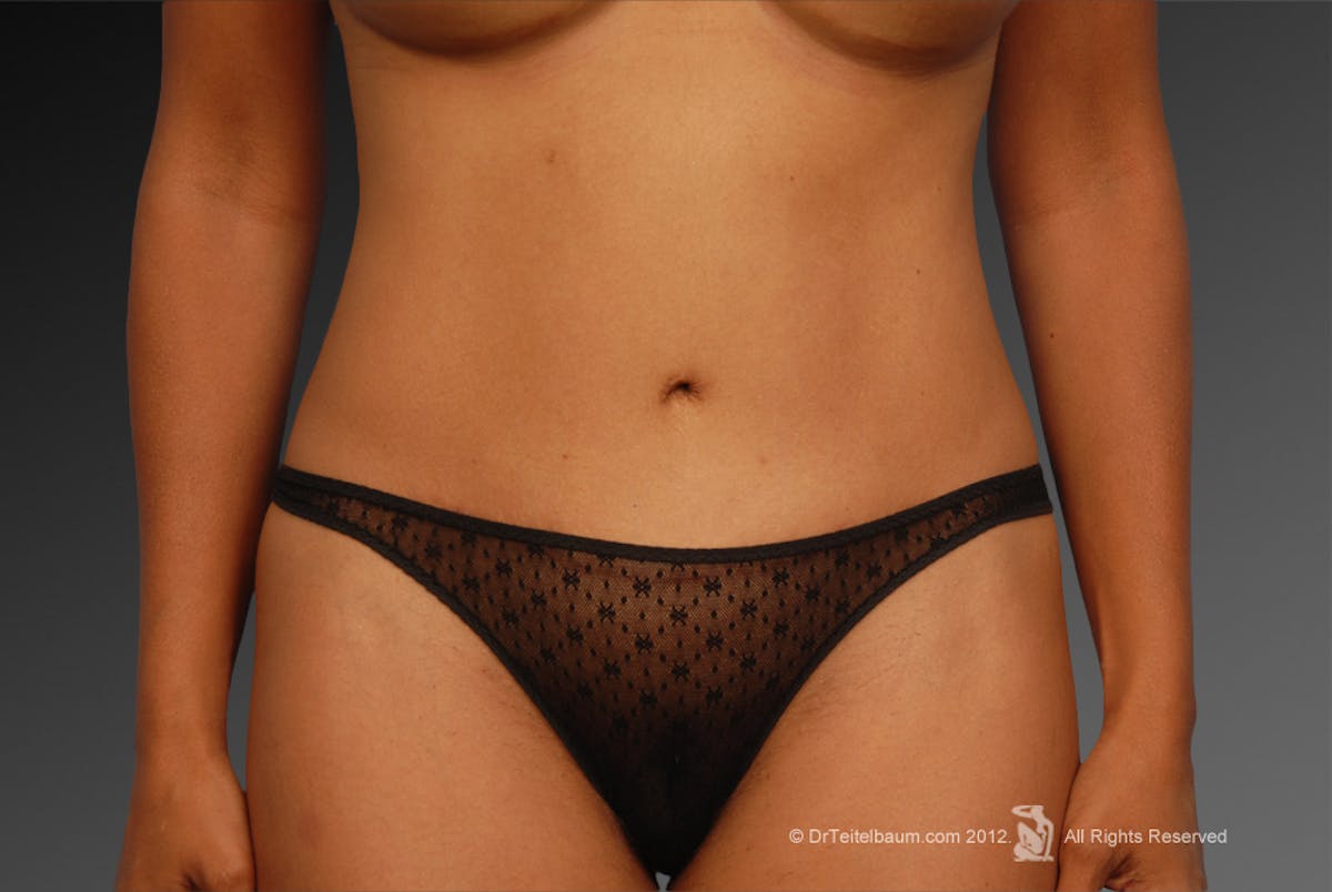 Tummy Tuck Before & After Gallery - Patient 105747912 - Image 1