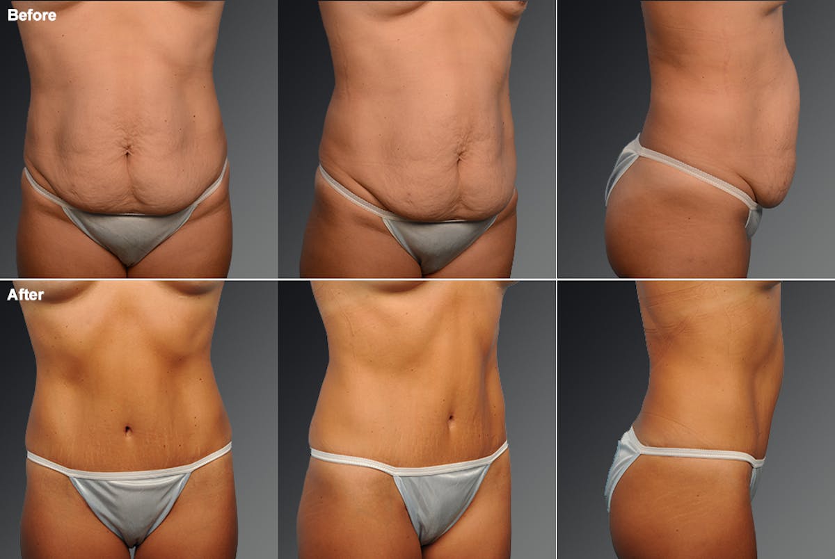 Tummy Tuck Before & After Gallery - Patient 105747913 - Image 1
