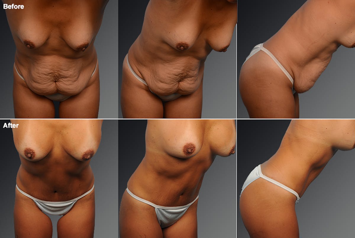 Tummy Tuck Before & After Gallery - Patient 105747914 - Image 1