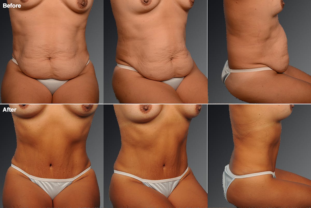 Tummy Tuck Before & After Gallery - Patient 105747915 - Image 1