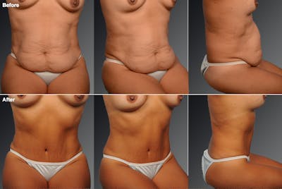 Tummy Tuck Before & After Gallery - Patient 105747915 - Image 1