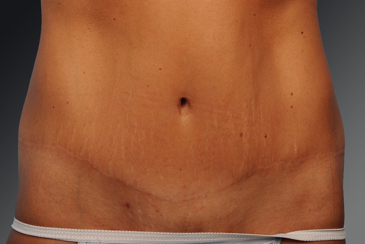 Tummy Tuck Before & After Gallery - Patient 105758916 - Image 1