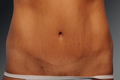 Tummy Tuck Before & After Gallery - Patient 105758916 - Image 1